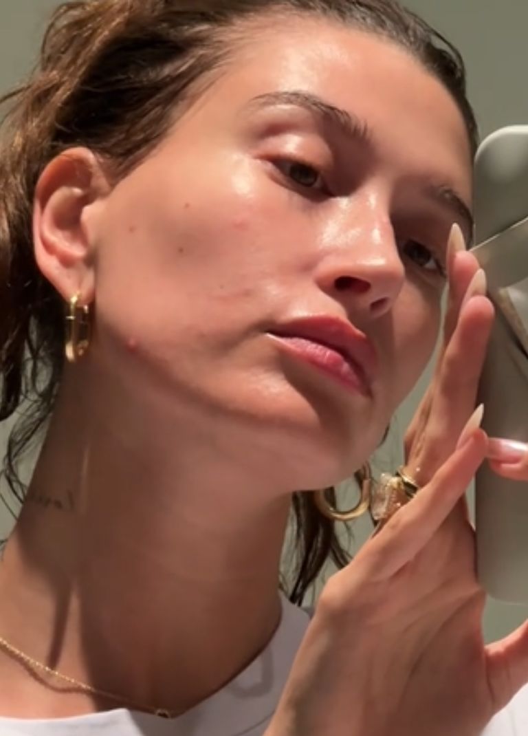 Hailey Bieber: Δείχνει την περιστοματική της δερματίτιδα στο TikTok – Eιδικός εξηγεί στο grace.gr τι είναι 2